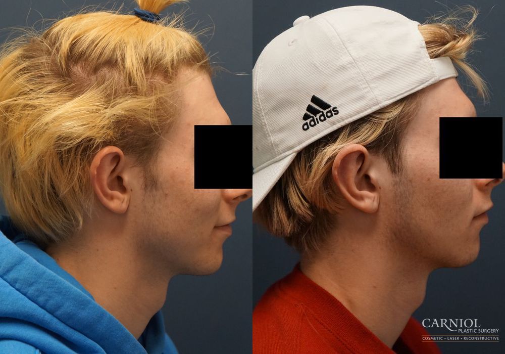 Otoplasty - Thumbnail 3