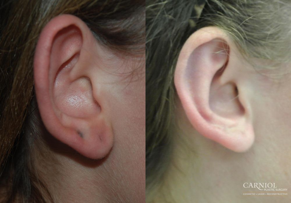 Otoplasty - Thumbnail 2