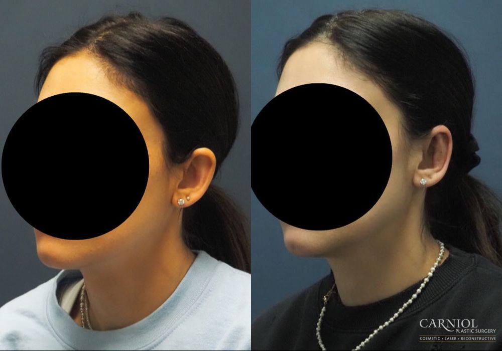 Otoplasty - Thumbnail 6