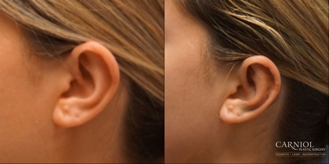 Otoplasty - Thumbnail 5