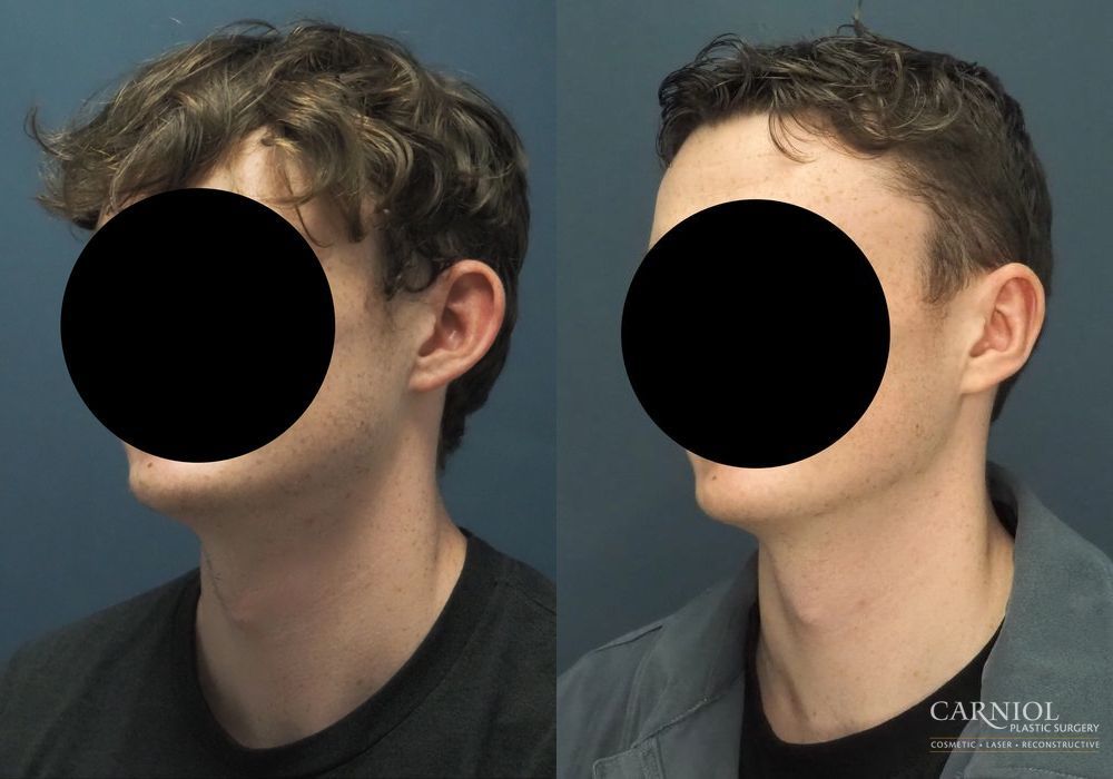 Otoplasty - Thumbnail 3