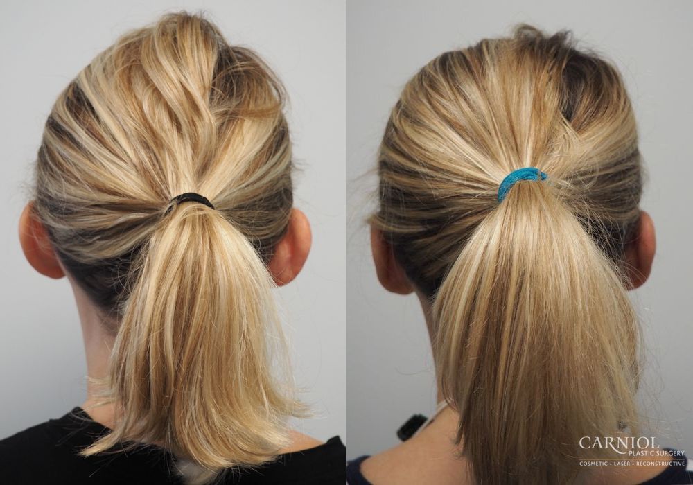 Otoplasty - Thumbnail 3