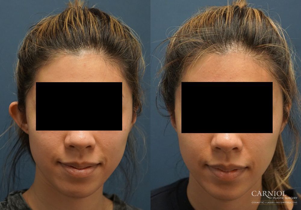 Otoplasty - Case 2455