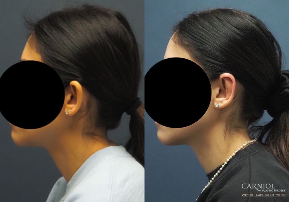 Otoplasty - Thumbnail 3