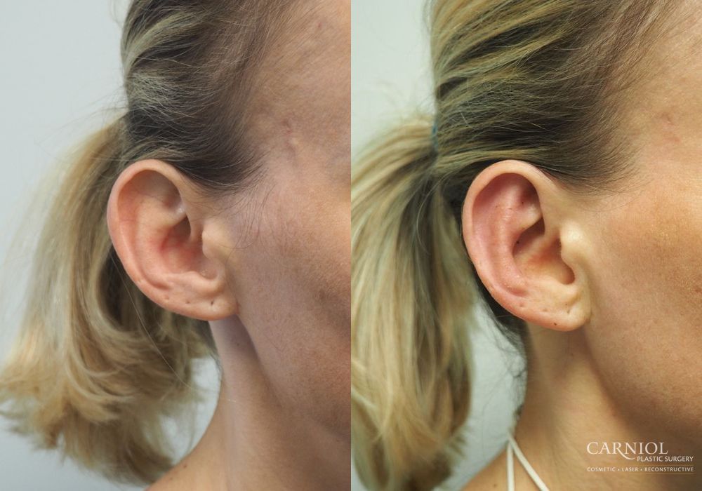 Otoplasty - Thumbnail 5