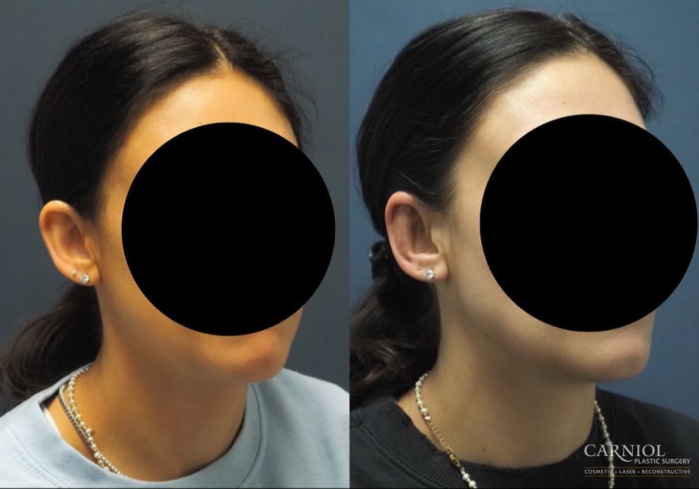 Otoplasty - Case 2453