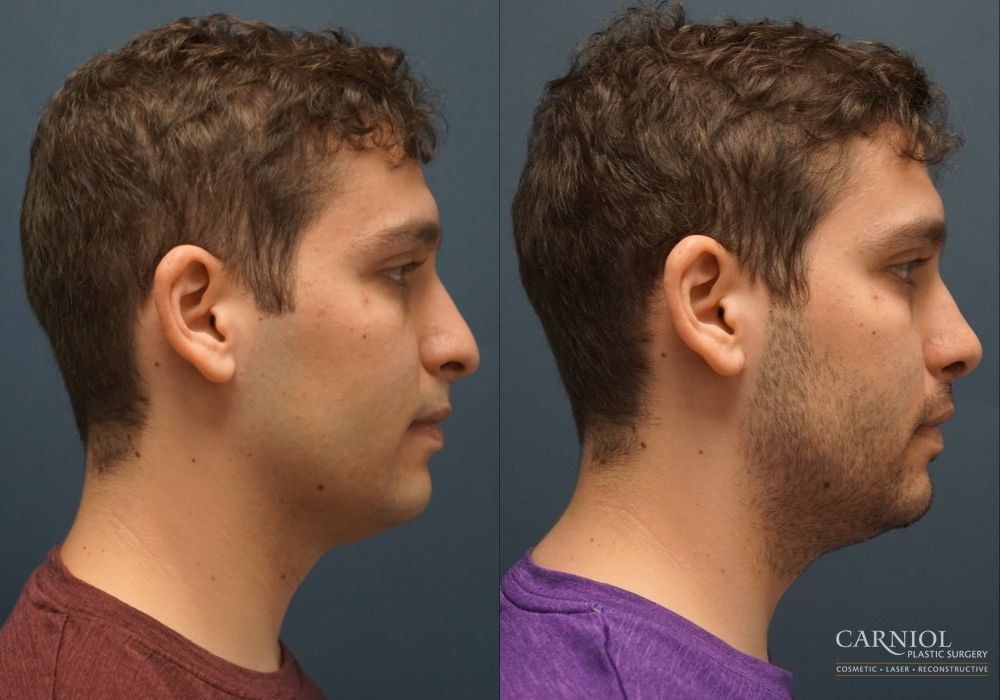 Rhinoplasty - Thumbnail 3