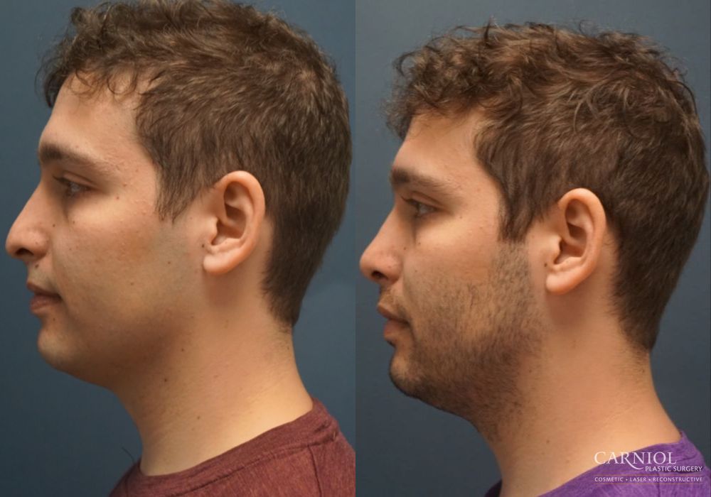 Rhinoplasty - Thumbnail 5