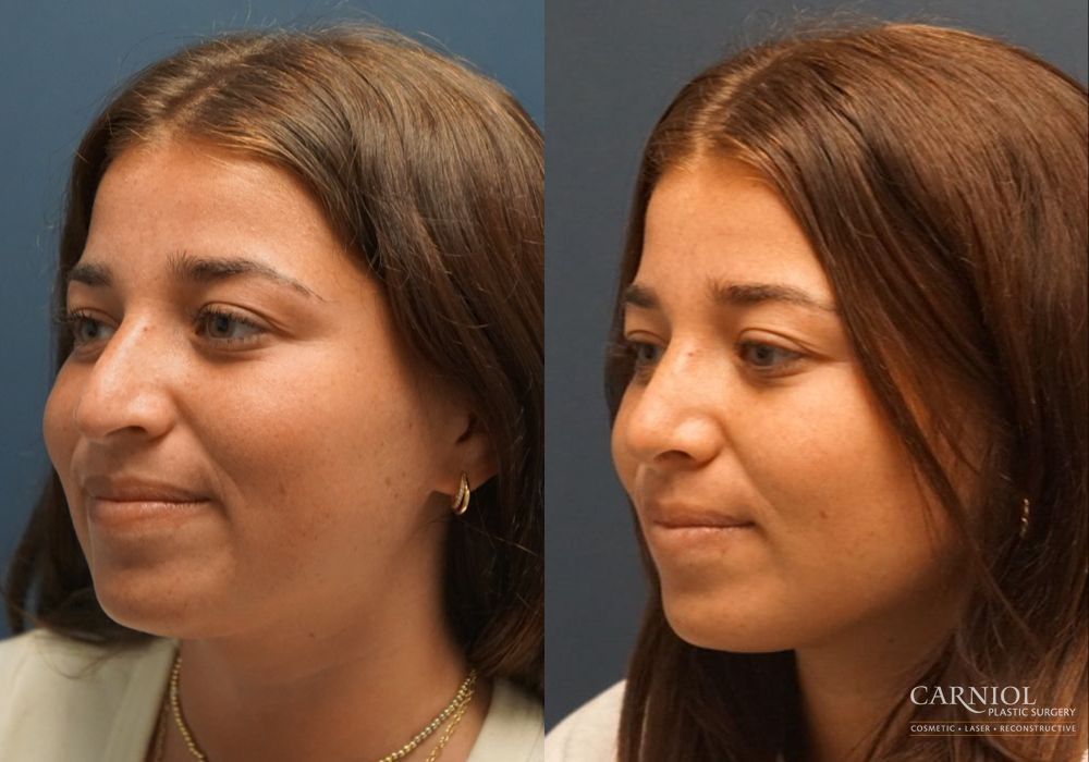 Rhinoplasty - Thumbnail 3