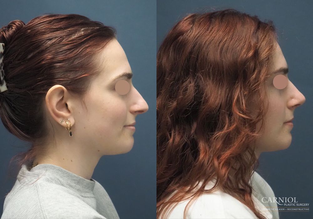 Rhinoplasty - Case 2764