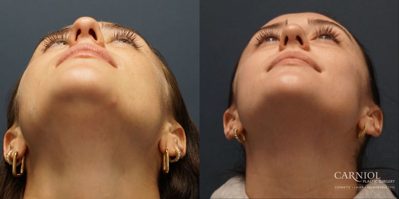 Rhinoplasty - Thumbnail 6