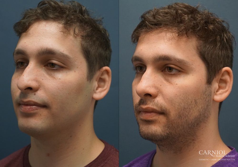 Rhinoplasty - Thumbnail 4