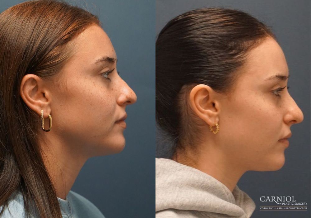 Rhinoplasty - Thumbnail 3