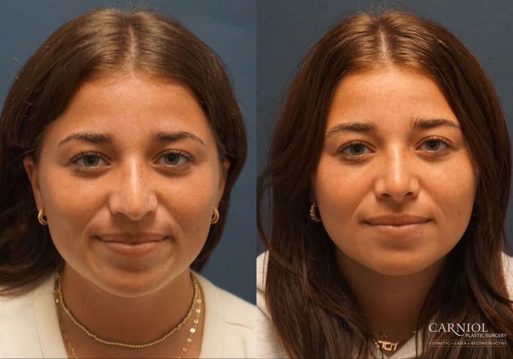 Rhinoplasty - Case 2762