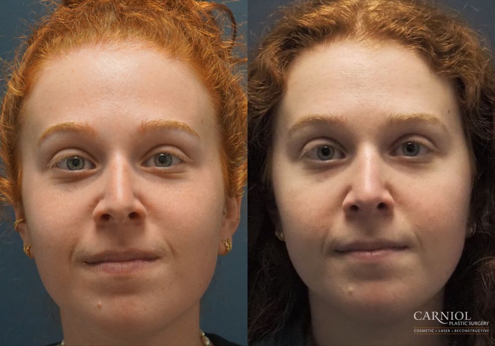 Rhinoplasty - Thumbnail 5