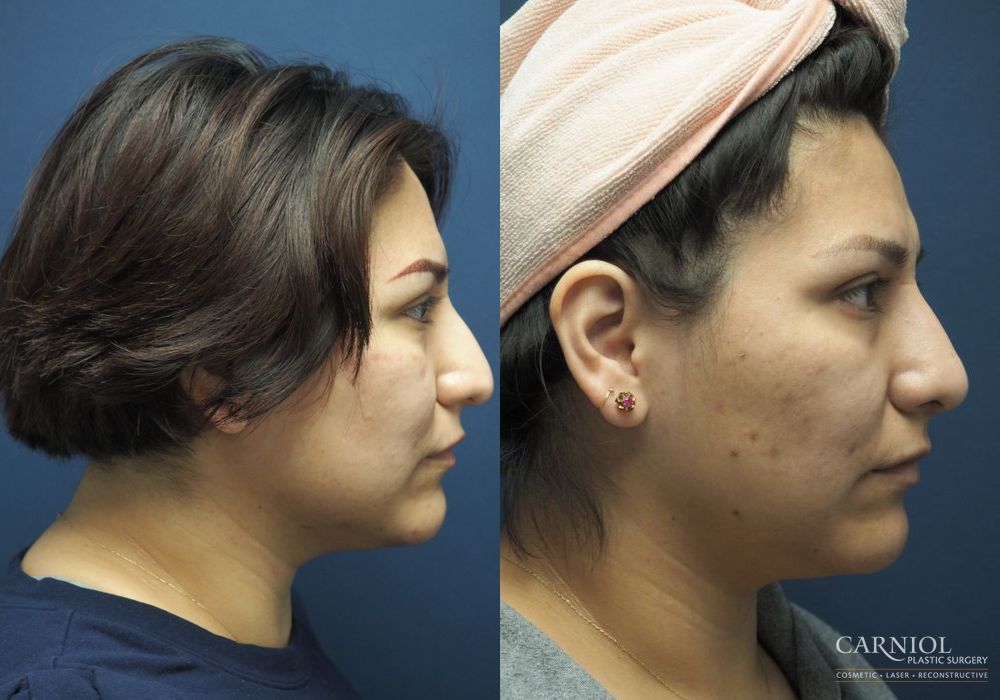 Rhinoplasty - Thumbnail 3