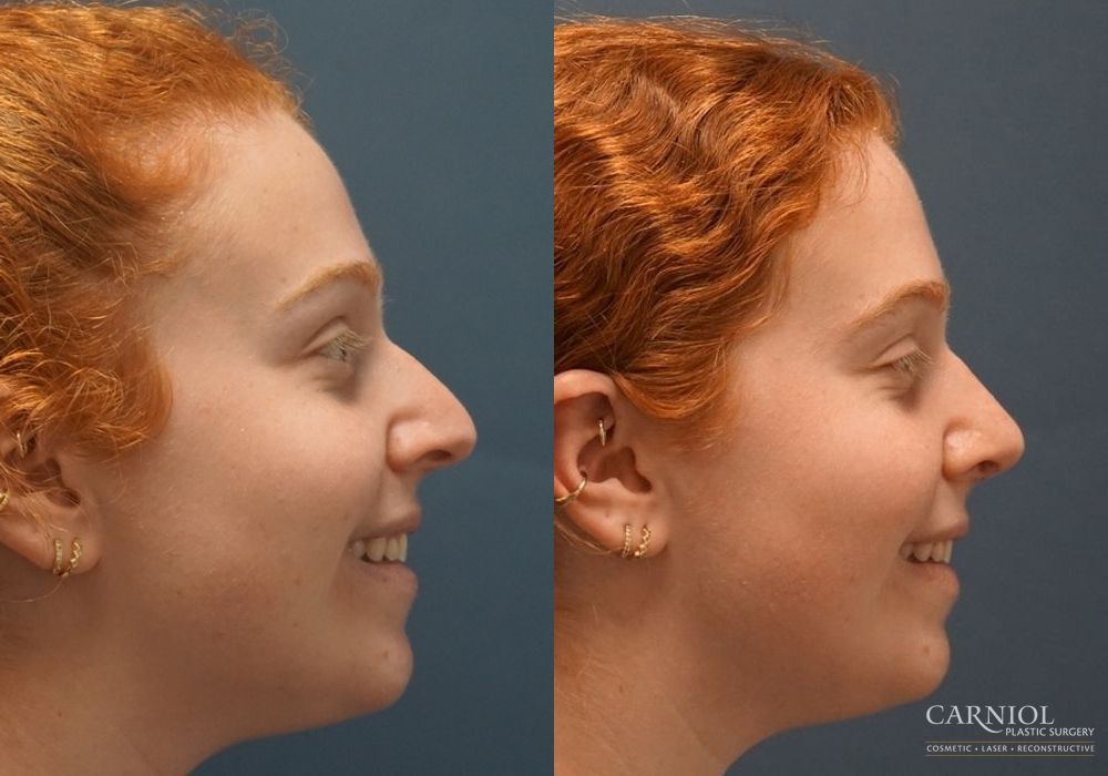 Rhinoplasty - Thumbnail 2