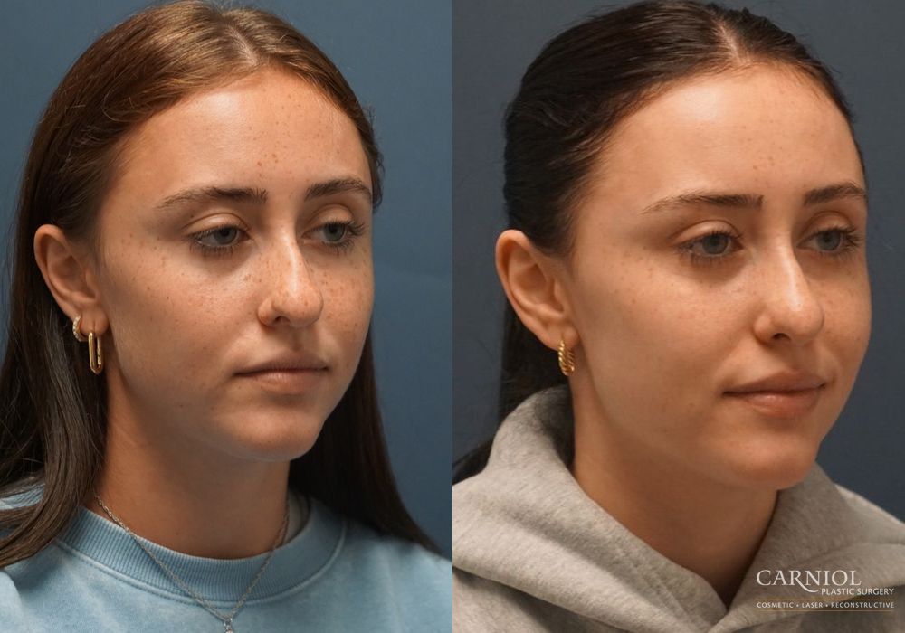 Rhinoplasty - Thumbnail 2