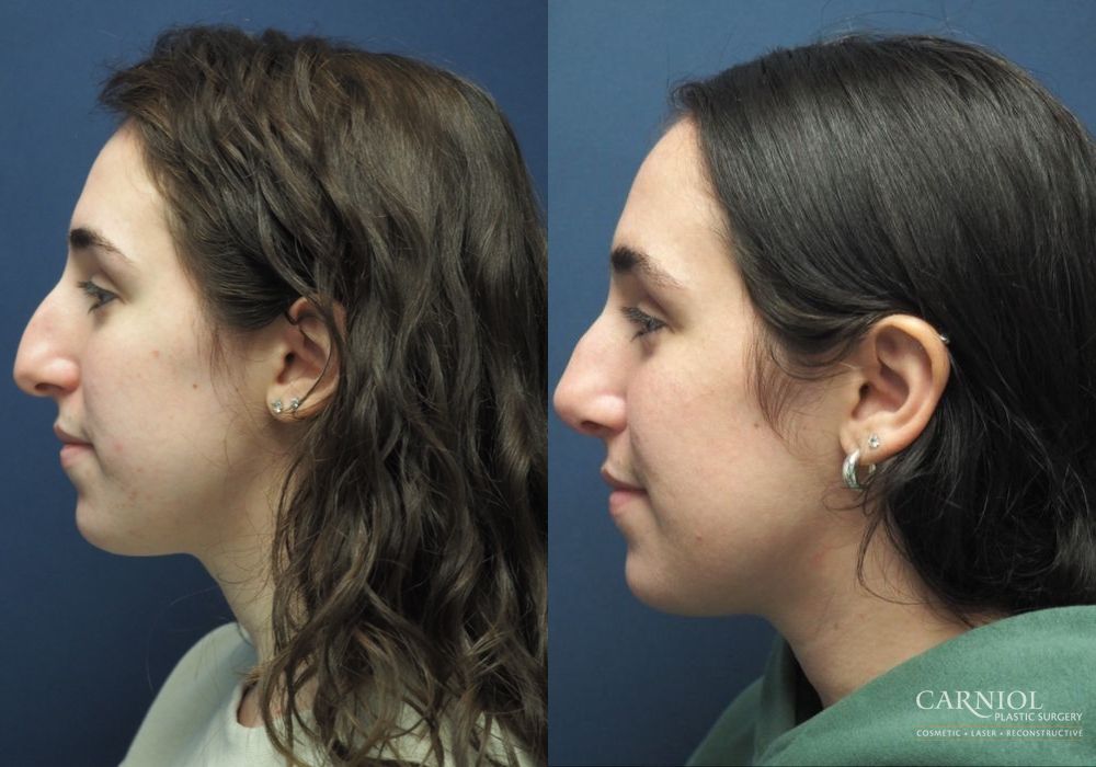 Rhinoplasty - Thumbnail 3