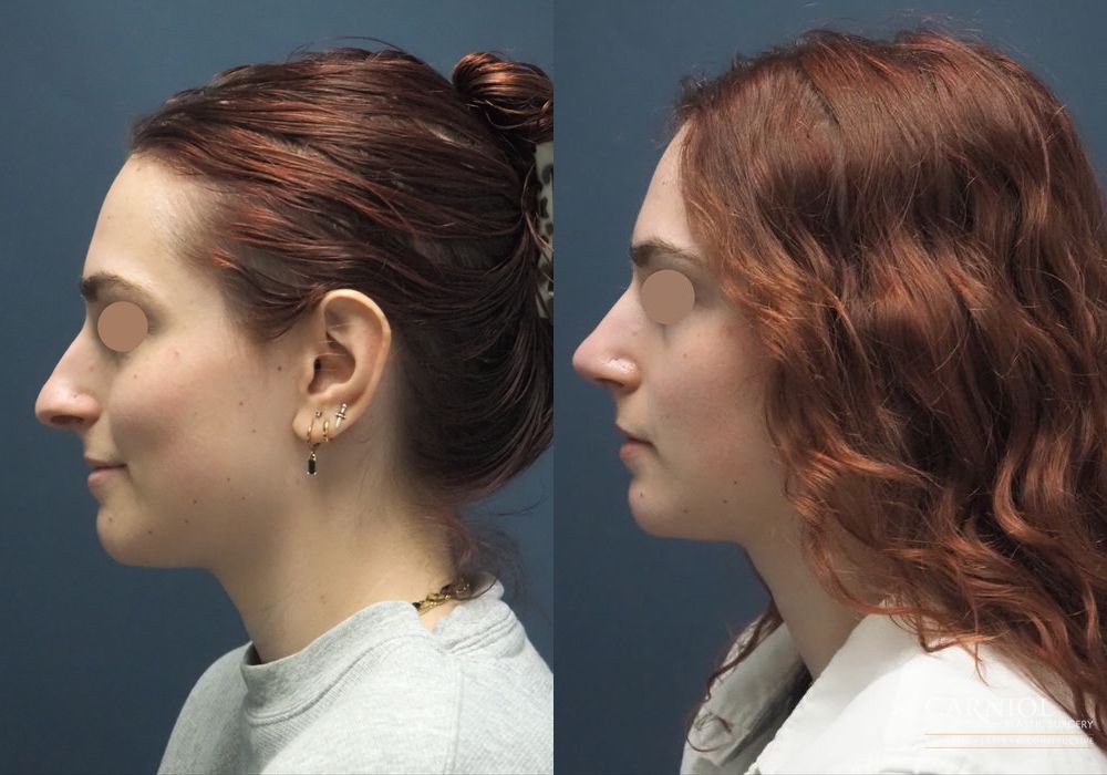 Rhinoplasty - Thumbnail 3