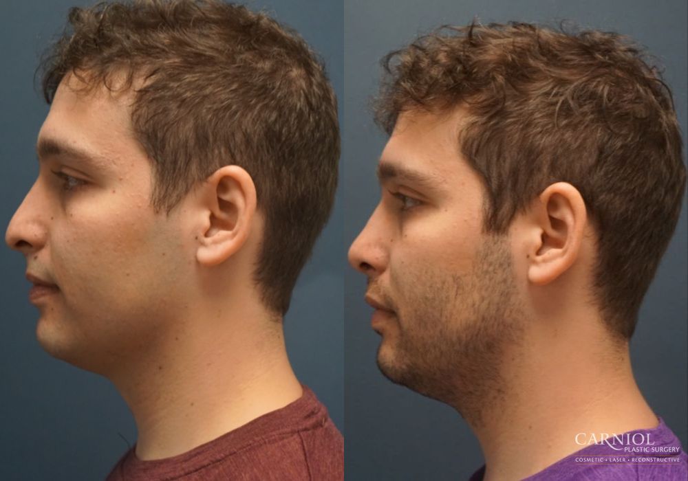 Rhinoplasty - Thumbnail 5