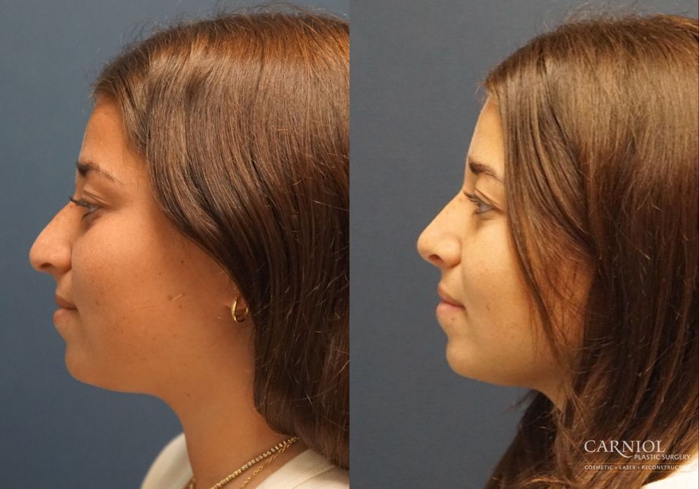 Rhinoplasty - Thumbnail 5