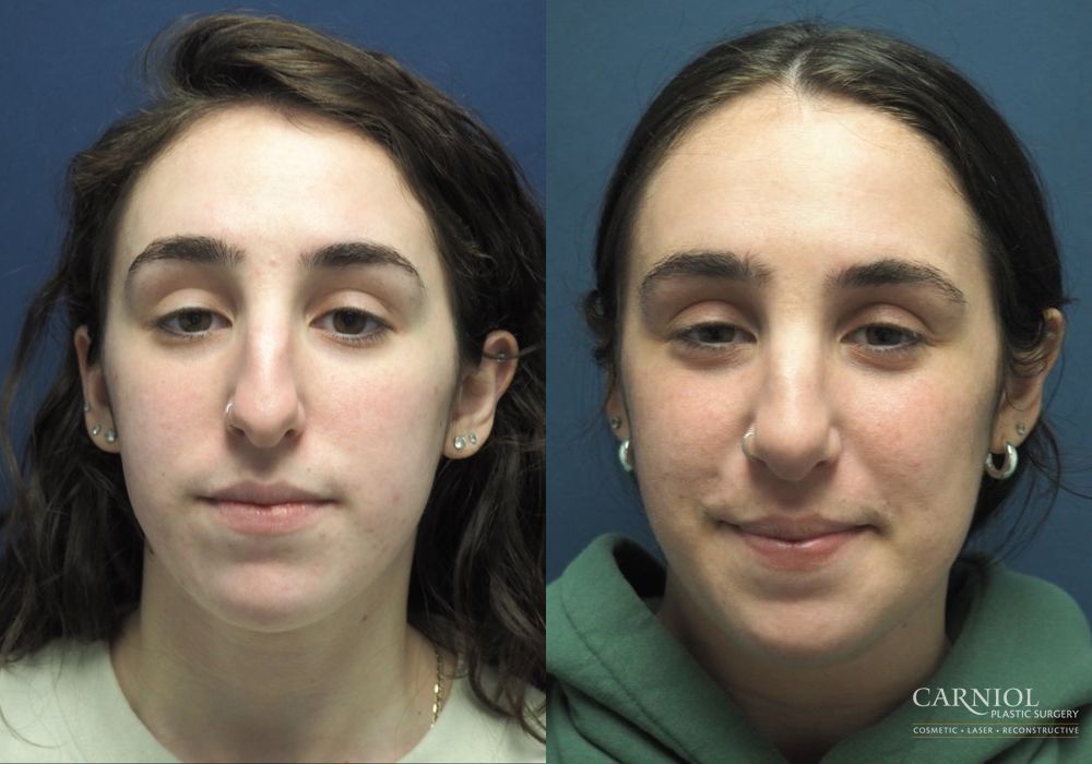 Rhinoplasty - Thumbnail 4