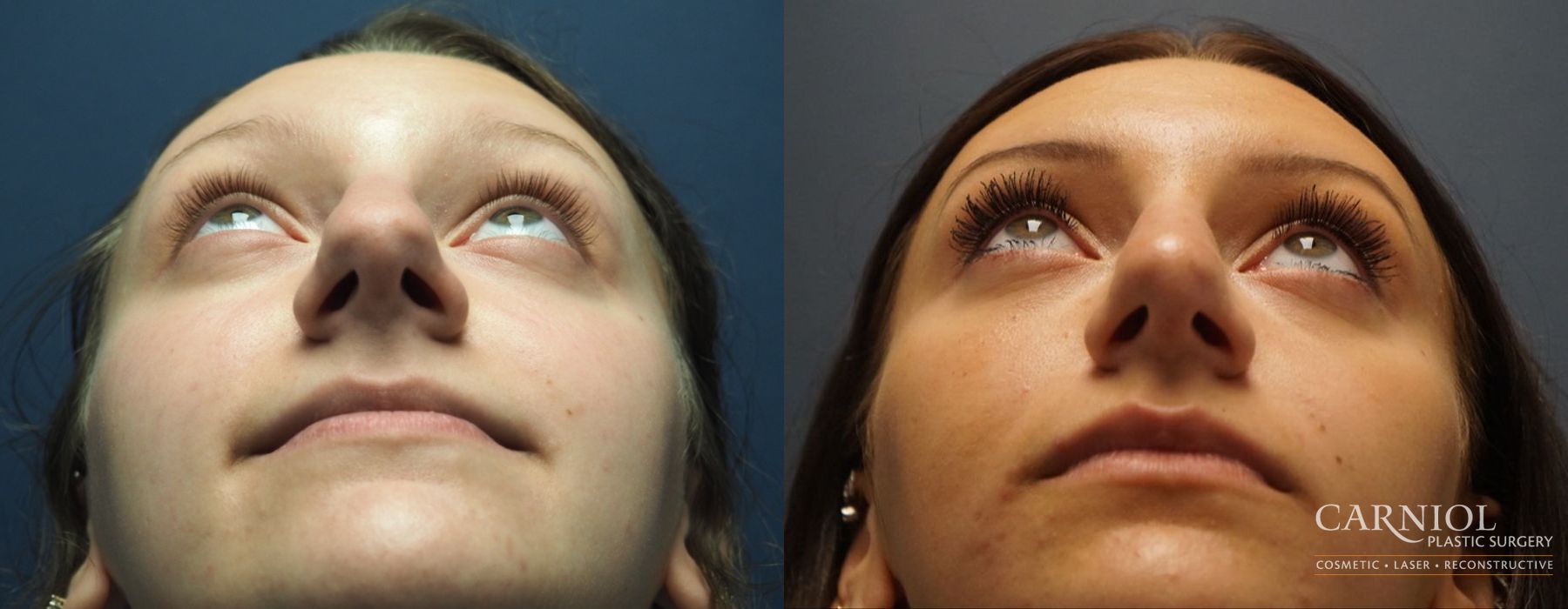 Rhinoplasty - Thumbnail 6