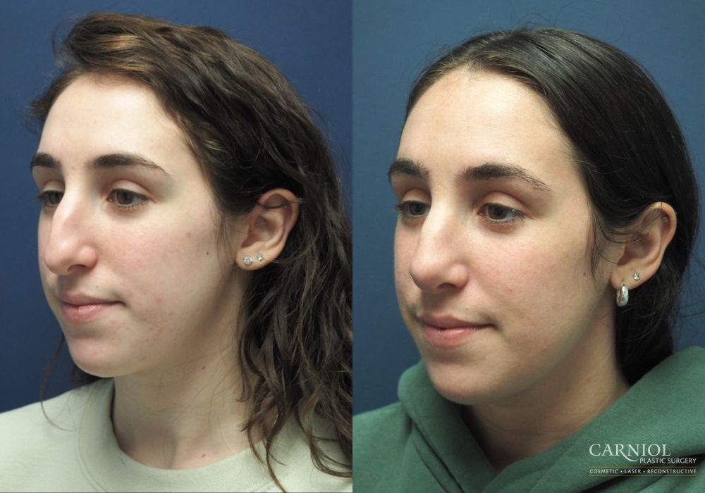 Rhinoplasty - Thumbnail 2