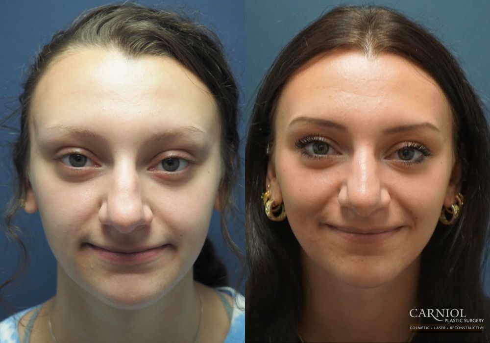 Rhinoplasty - Case 2763