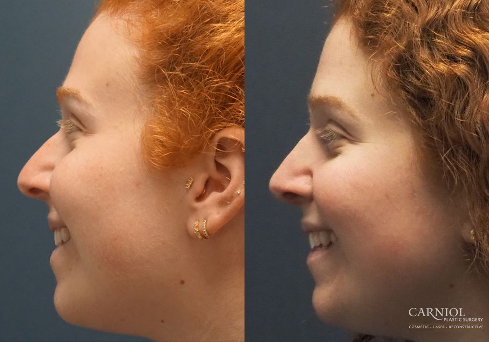 Rhinoplasty - Thumbnail 3