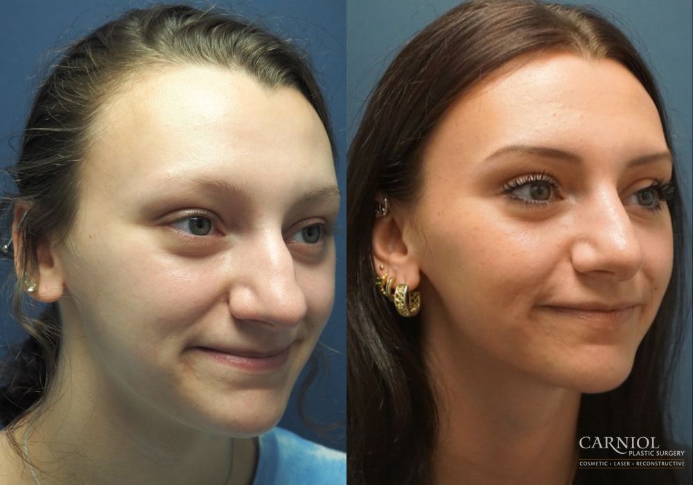 Rhinoplasty - Thumbnail 2