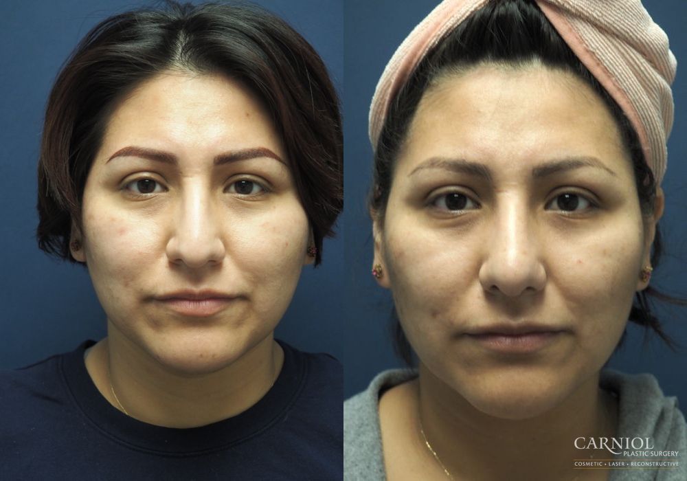 Rhinoplasty - Case 2464