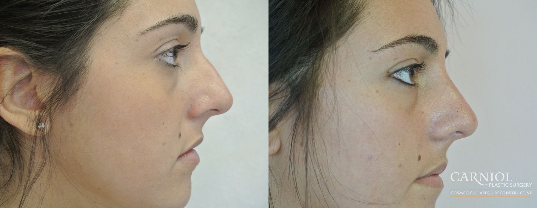 Rhinoplasty - Case 2754