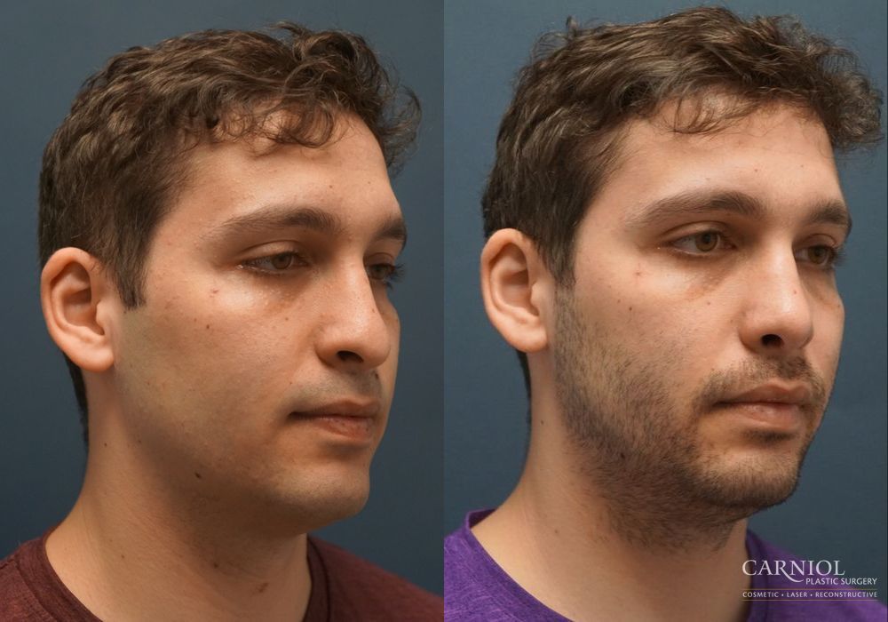 Rhinoplasty - Thumbnail 2