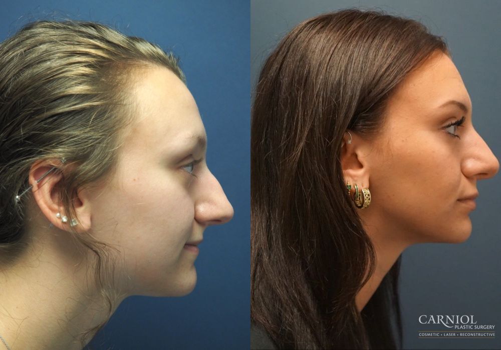 Rhinoplasty - Thumbnail 4