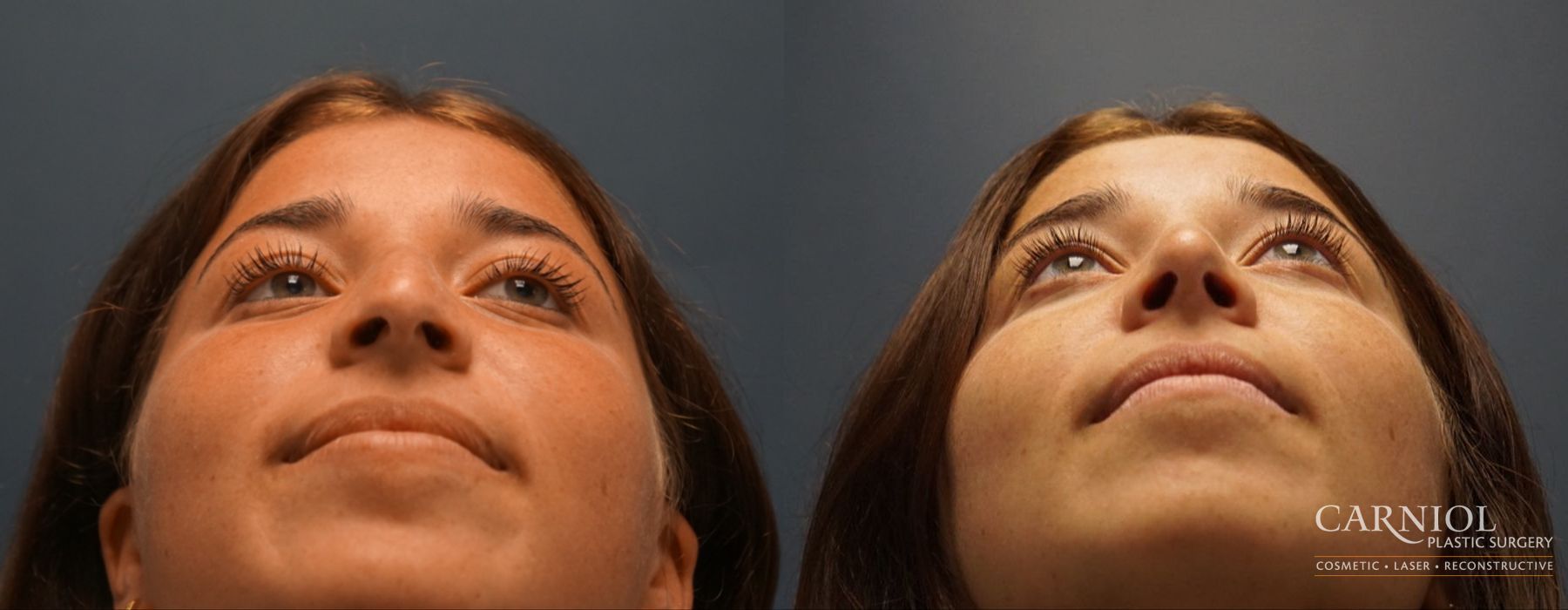 Rhinoplasty - Thumbnail 6