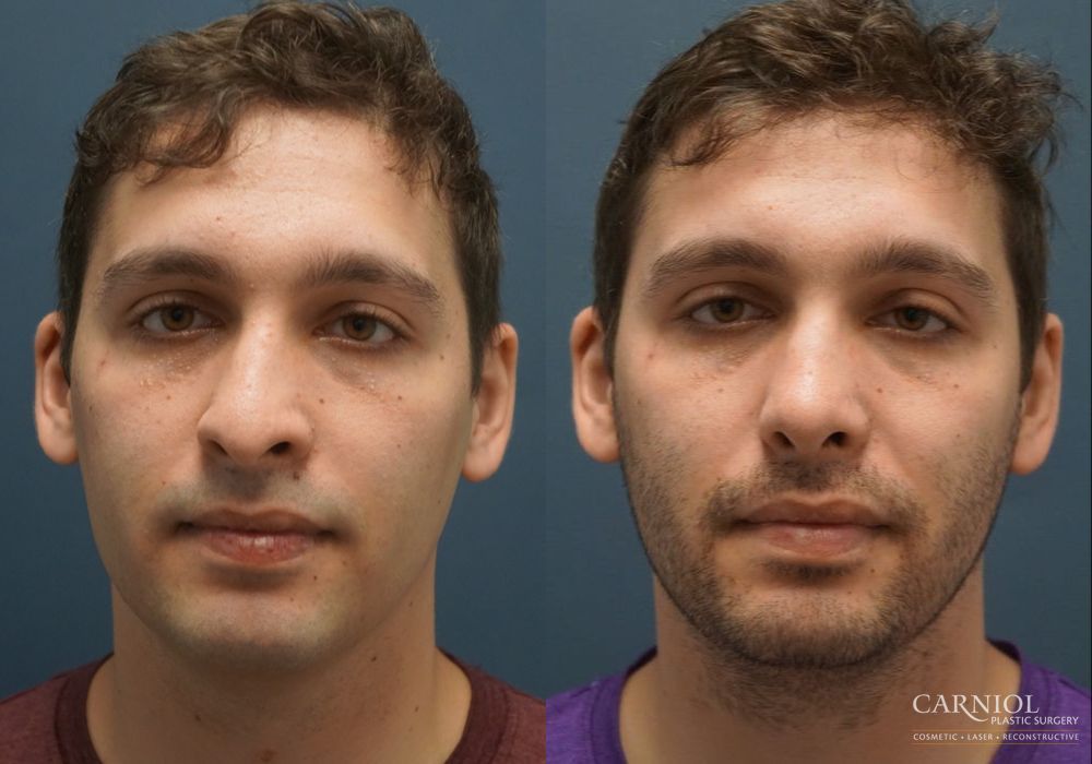 Rhinoplasty - Case 2467