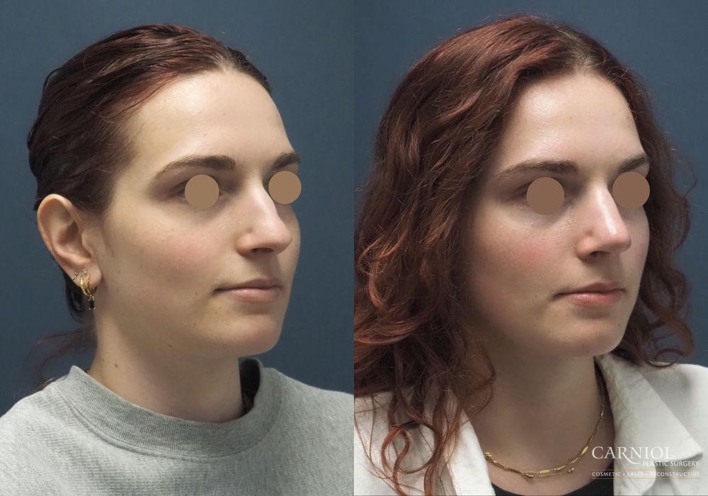 Rhinoplasty - Thumbnail 2