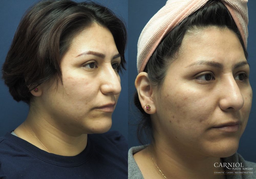 Rhinoplasty - Thumbnail 2