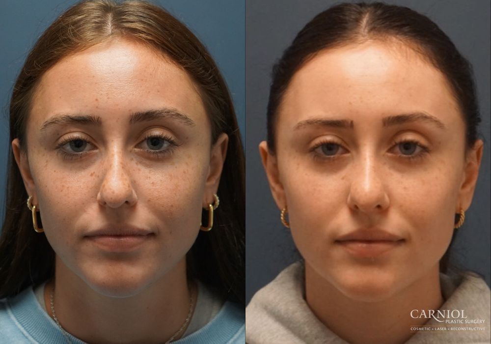 Rhinoplasty - Case 2759