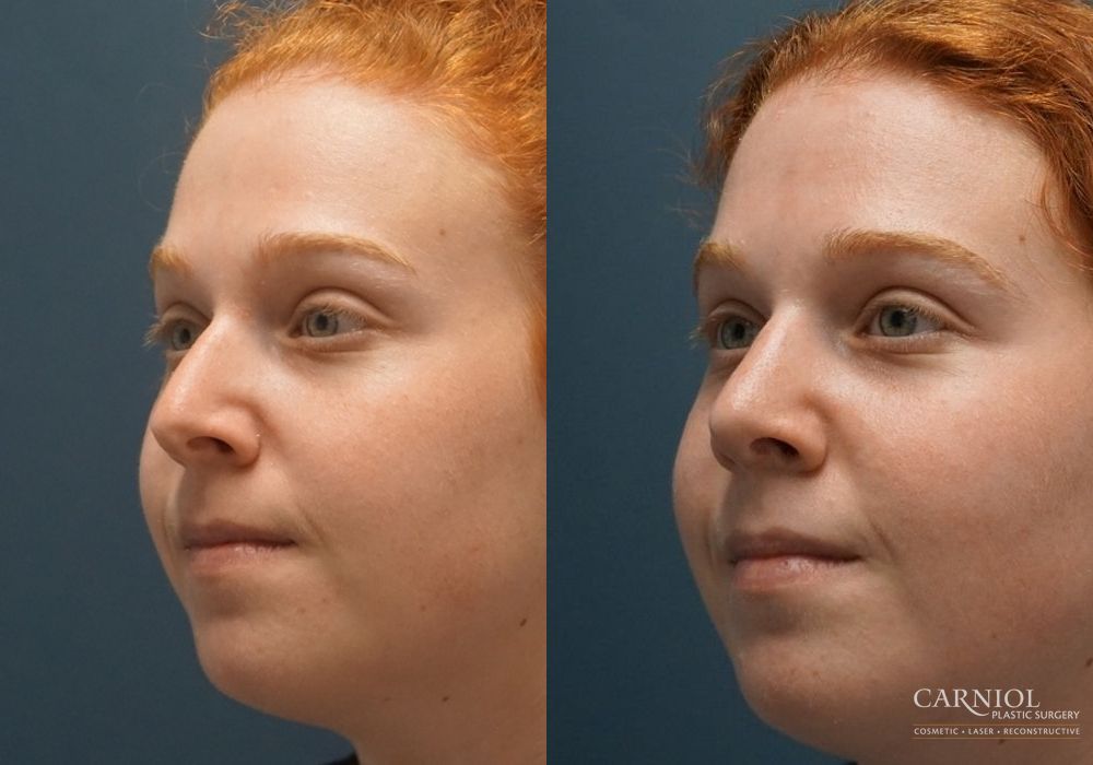 Rhinoplasty - Thumbnail 2