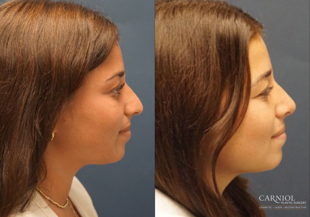 Rhinoplasty - Thumbnail 4