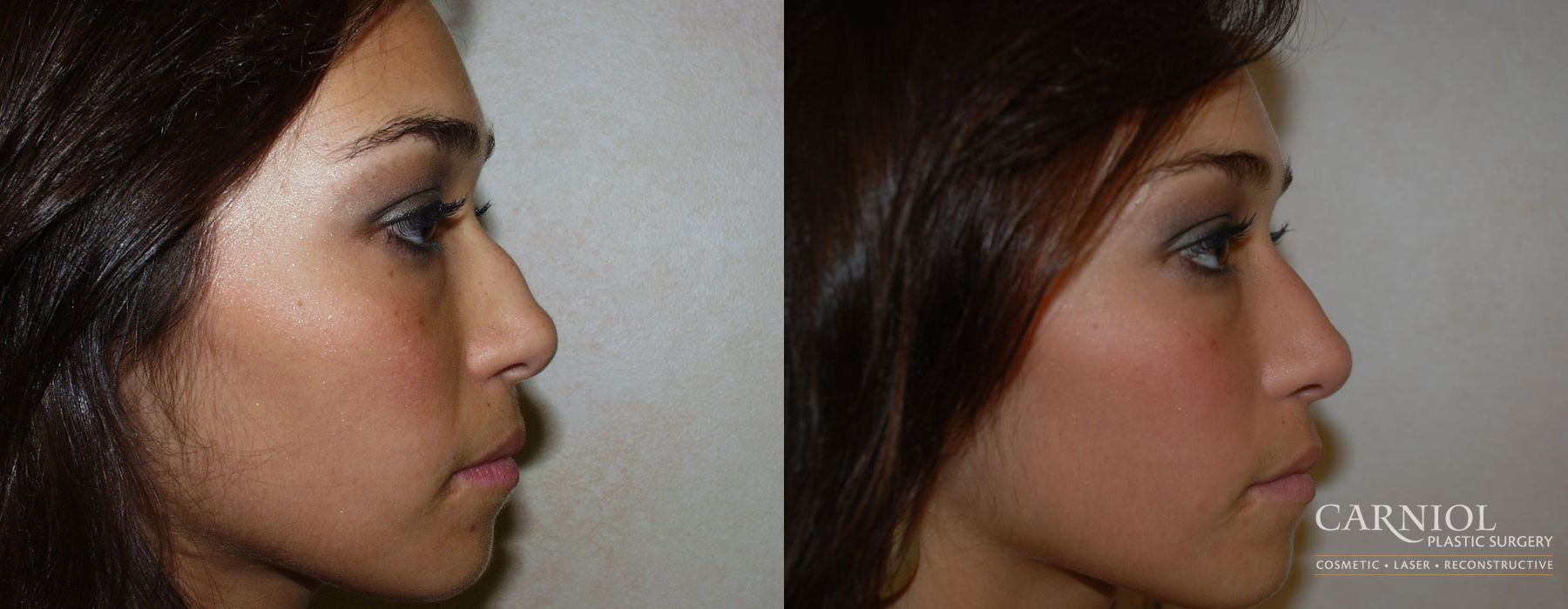 Rhinoplasty - Case 2753