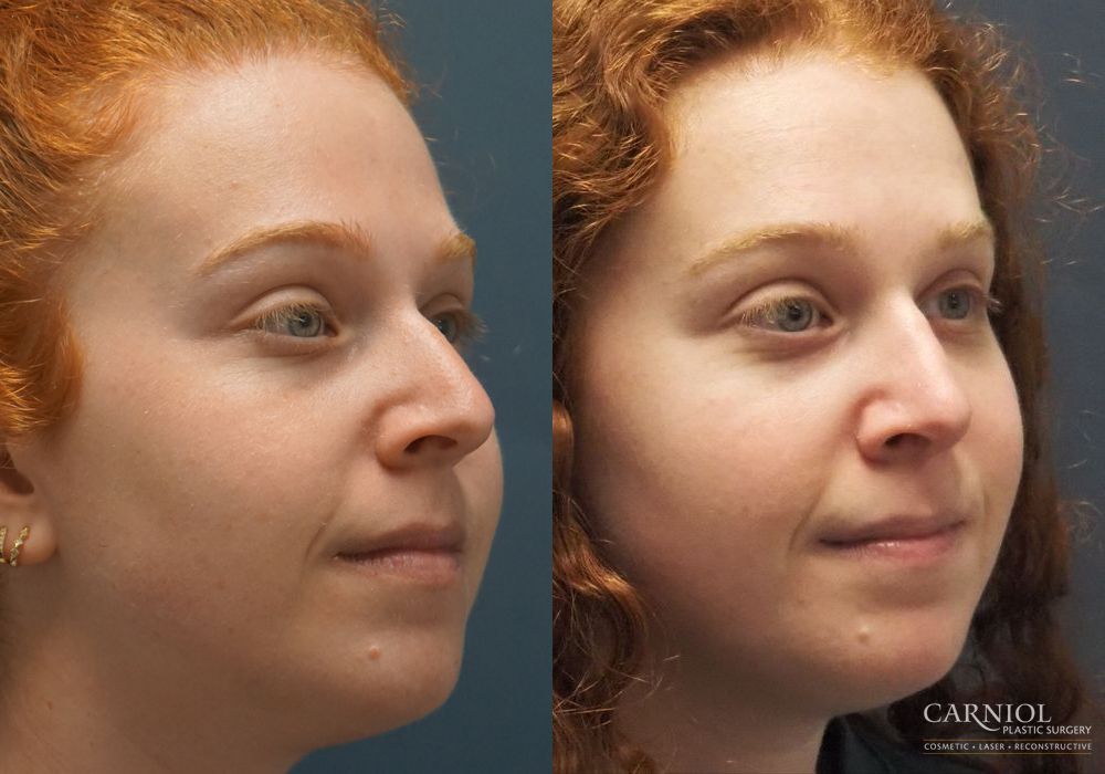 Rhinoplasty - Thumbnail 3