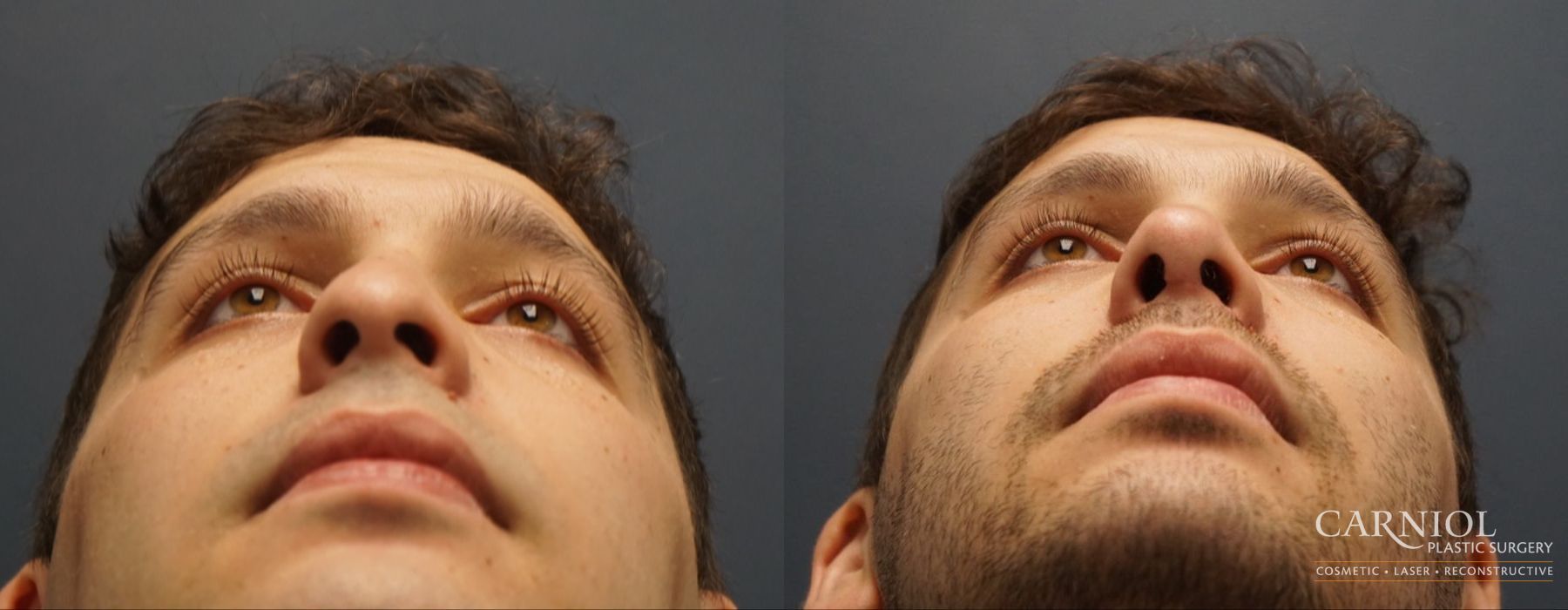 Rhinoplasty - Thumbnail 6