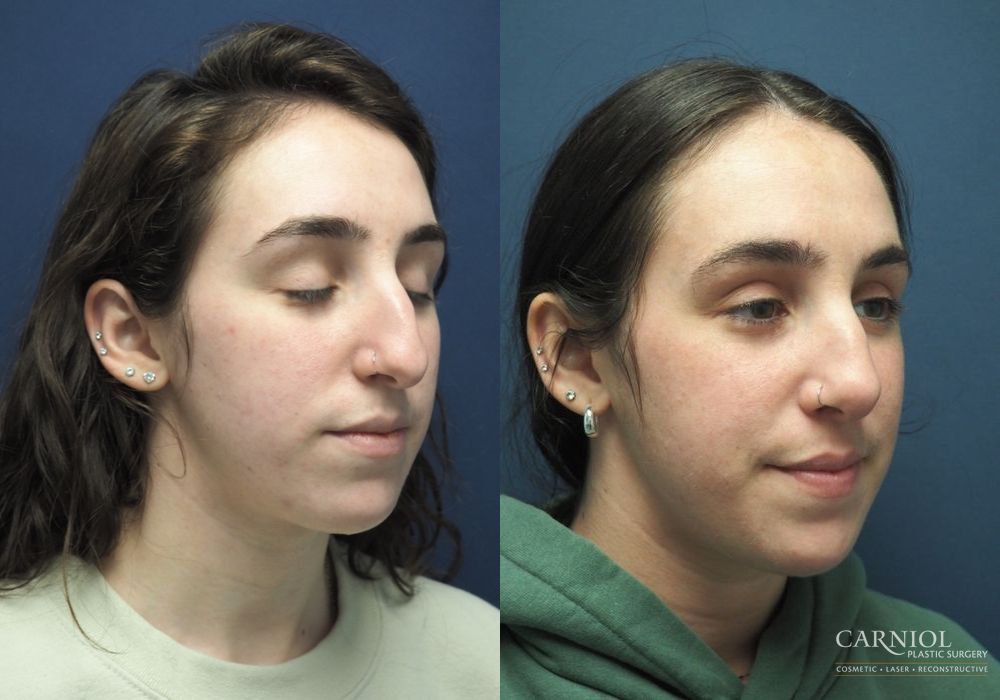 Rhinoplasty - Case 2761