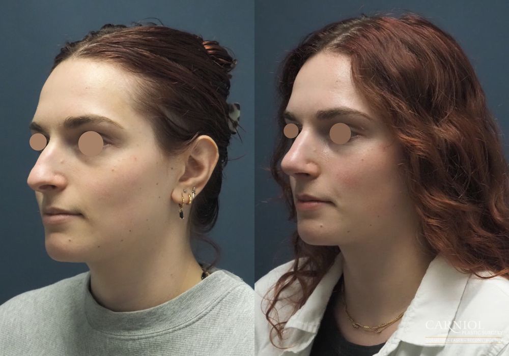 Rhinoplasty - Thumbnail 4