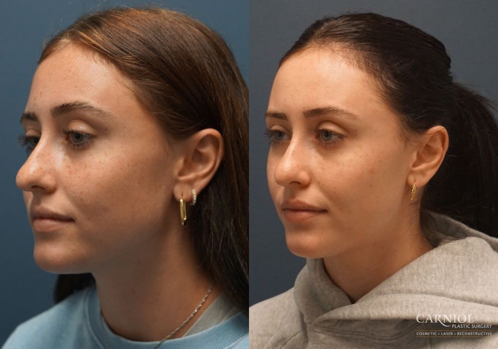 Rhinoplasty - Thumbnail 4