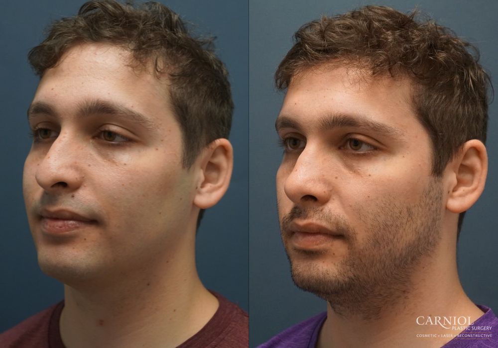 Rhinoplasty - Thumbnail 4